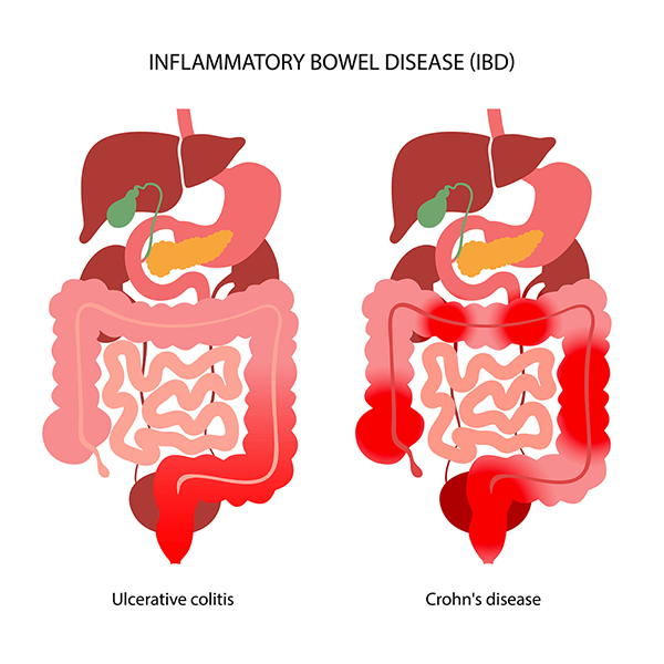 inflammatory-bowel-disease-graphic-large