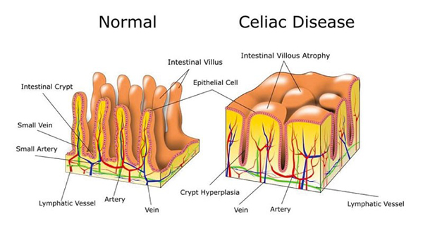 celiac_disease-600